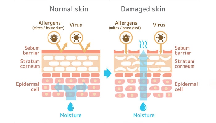 Structure of normal and damaged skin barrier